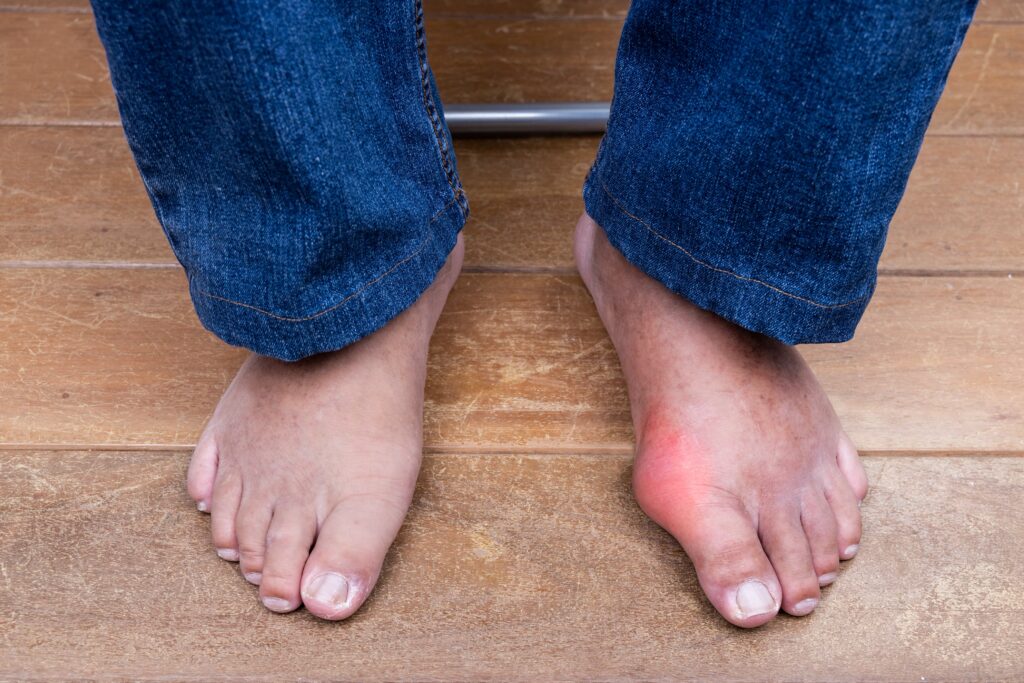 Bunion Pain Symptoms: Warning Signs You Shouldn’t Ignore