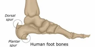 Heel Spurs