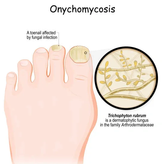 Toenail Fungus