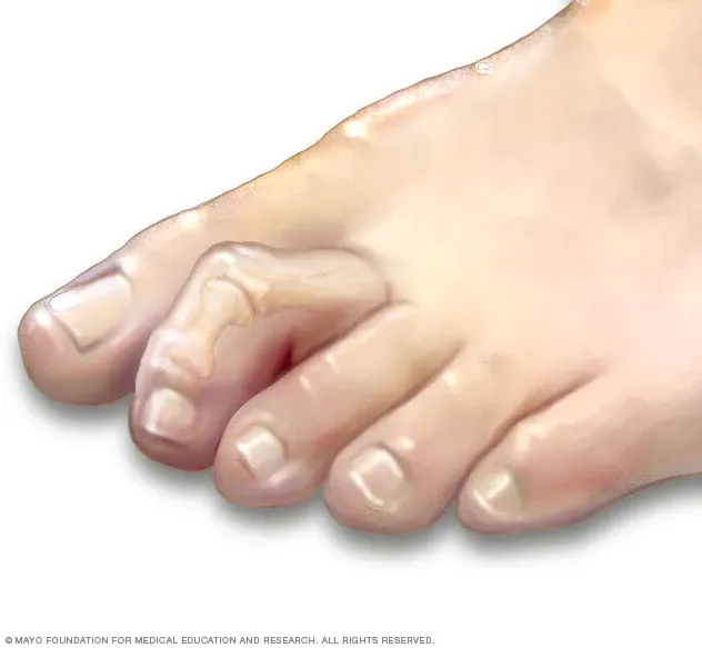 Hammertoes