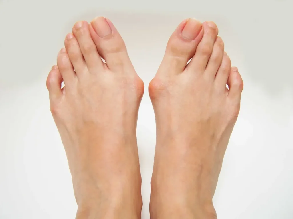 Bunions