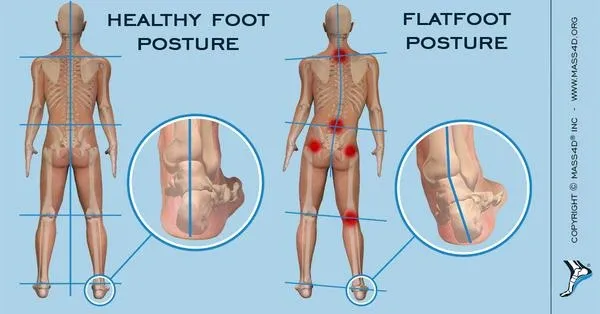 How Your Foot Health Affects Your Posture