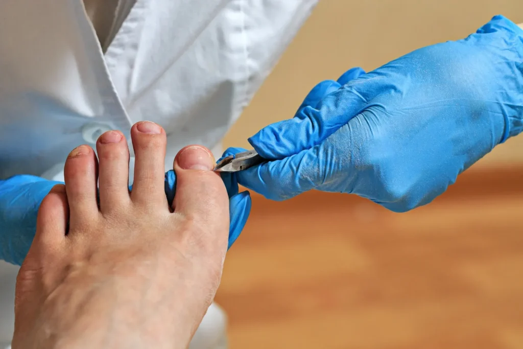 Podiatrist performing ingrown toenail treatment on a patient's foot, showcasing proper nail care techniques.