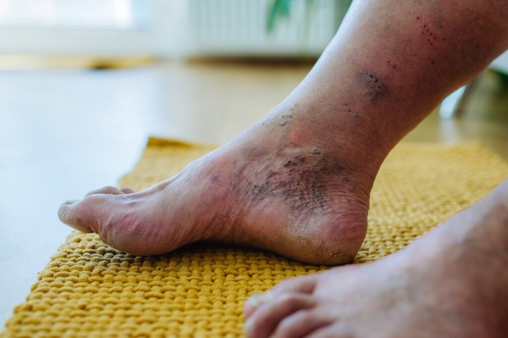 Close-up of a man's feet showing diabetic foot complications, including discoloration and skin issues, on a textured yellow mat, emphasizing the importance of diabetic foot care.