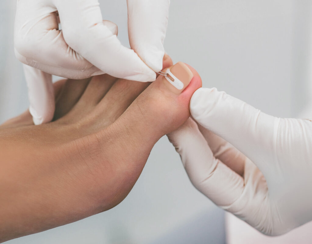 Podiatrist treating ingrown toenail with sterile tools, emphasizing foot health care at OpenSky Podiatry in Chicago.