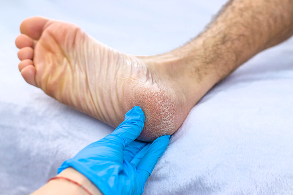 Close-up of male foot with dry skin on the heel, being examined by a podiatrist in blue gloves, highlighting foot health concerns relevant to athlete's foot and other podiatric conditions.