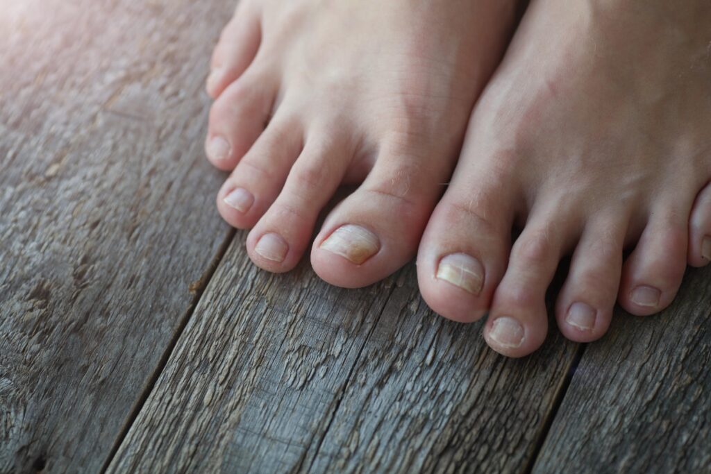 Is an Ingrown Toenail Dangerous?