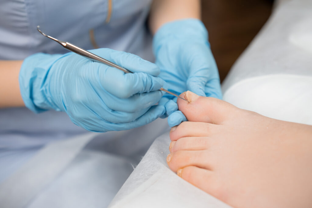 Ingrown Toenail Removal in Skokie: Procedure and Healing Time